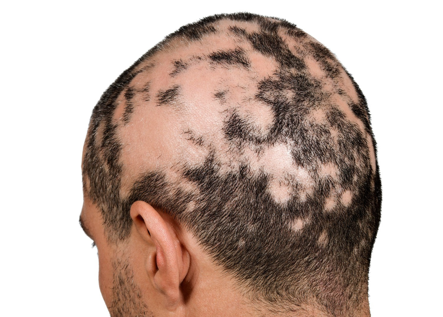 what to expect after glutathione iv Glutathione IV Therapy: What You Need to Know