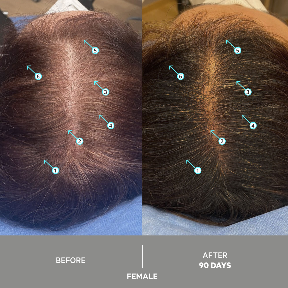 SPECTRAL EXTRA STRENGTH® | 7% Nanoxidil
