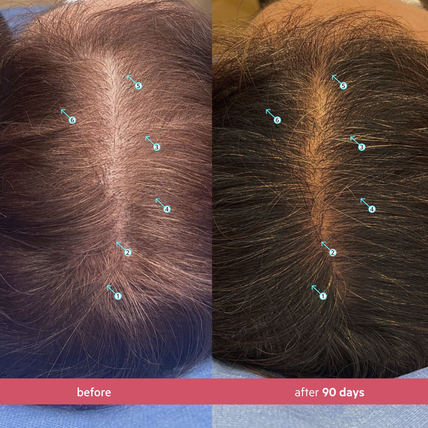 Spectral Women's (CSF) 3 Month Supply | Revitalizing Serum for Women with Nanoxidil 5%
