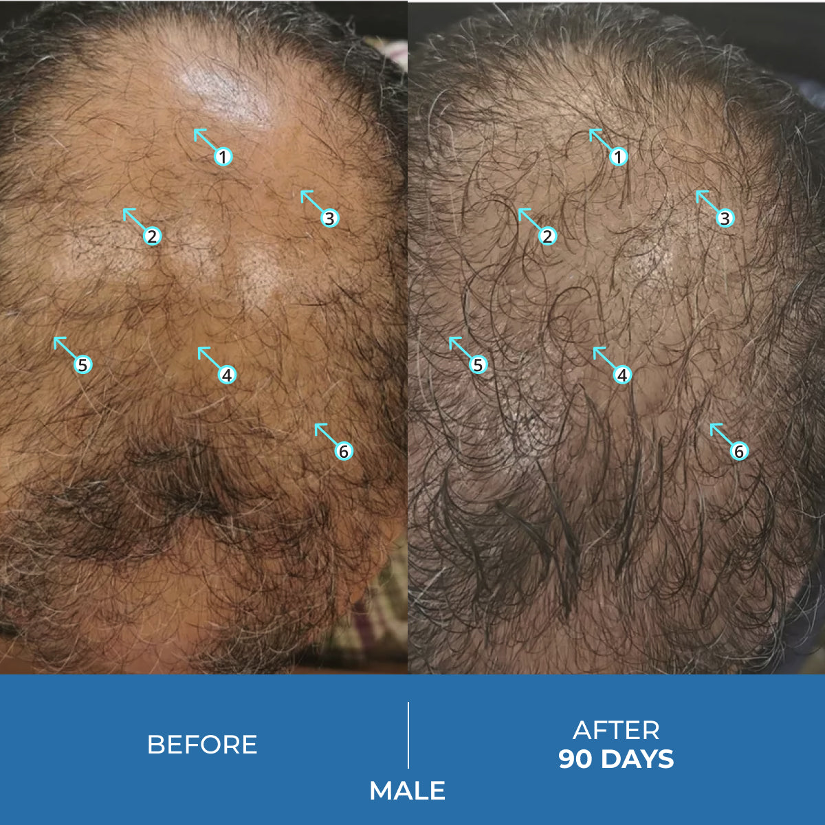 Spectral.UHP 3 Month Supply | Extra Strength Hair Regrowth Treatment with Minoxidil 5%