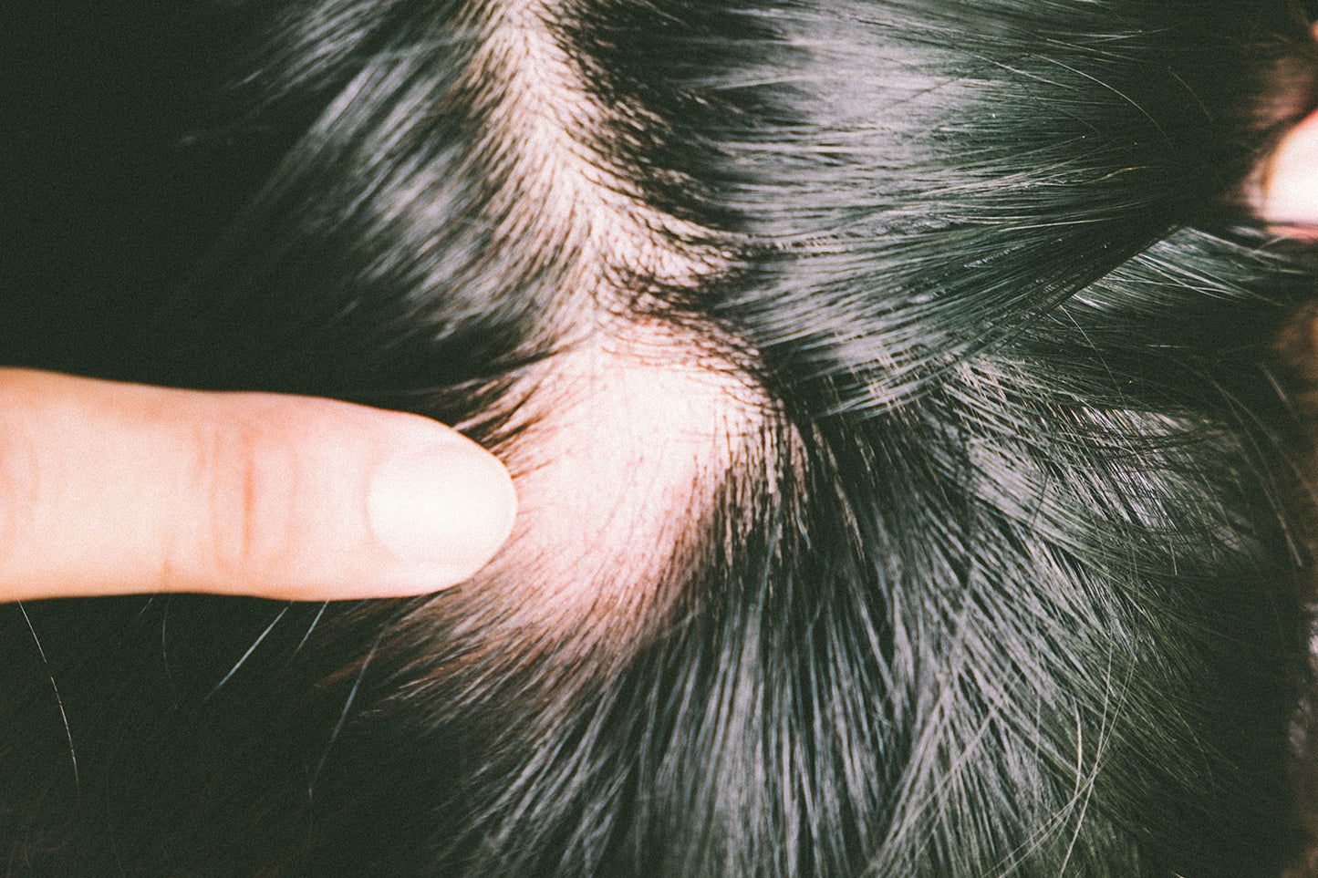 How to Prevent Alopecia Areata Hair Loss