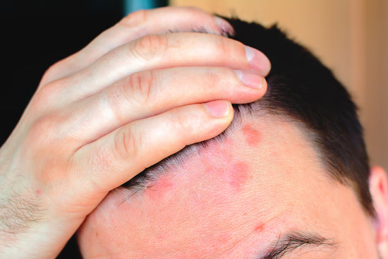 Can psoriasis lead to hair loss? (What you should know)