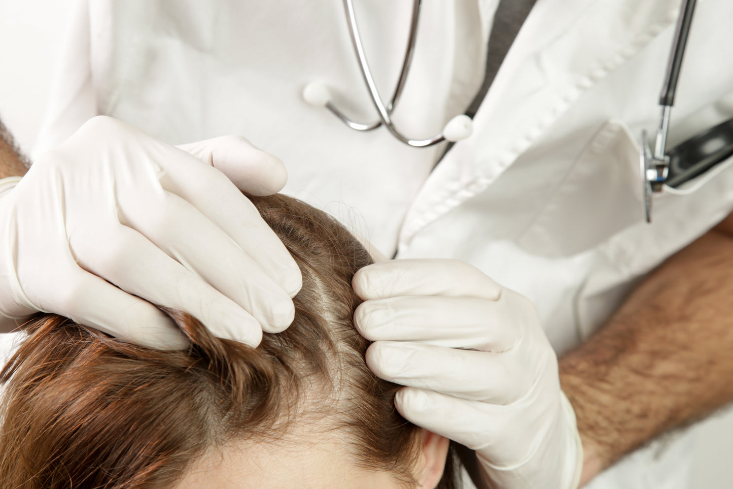 Is There a Connection Between Cholesterol Levels and Hair Loss?