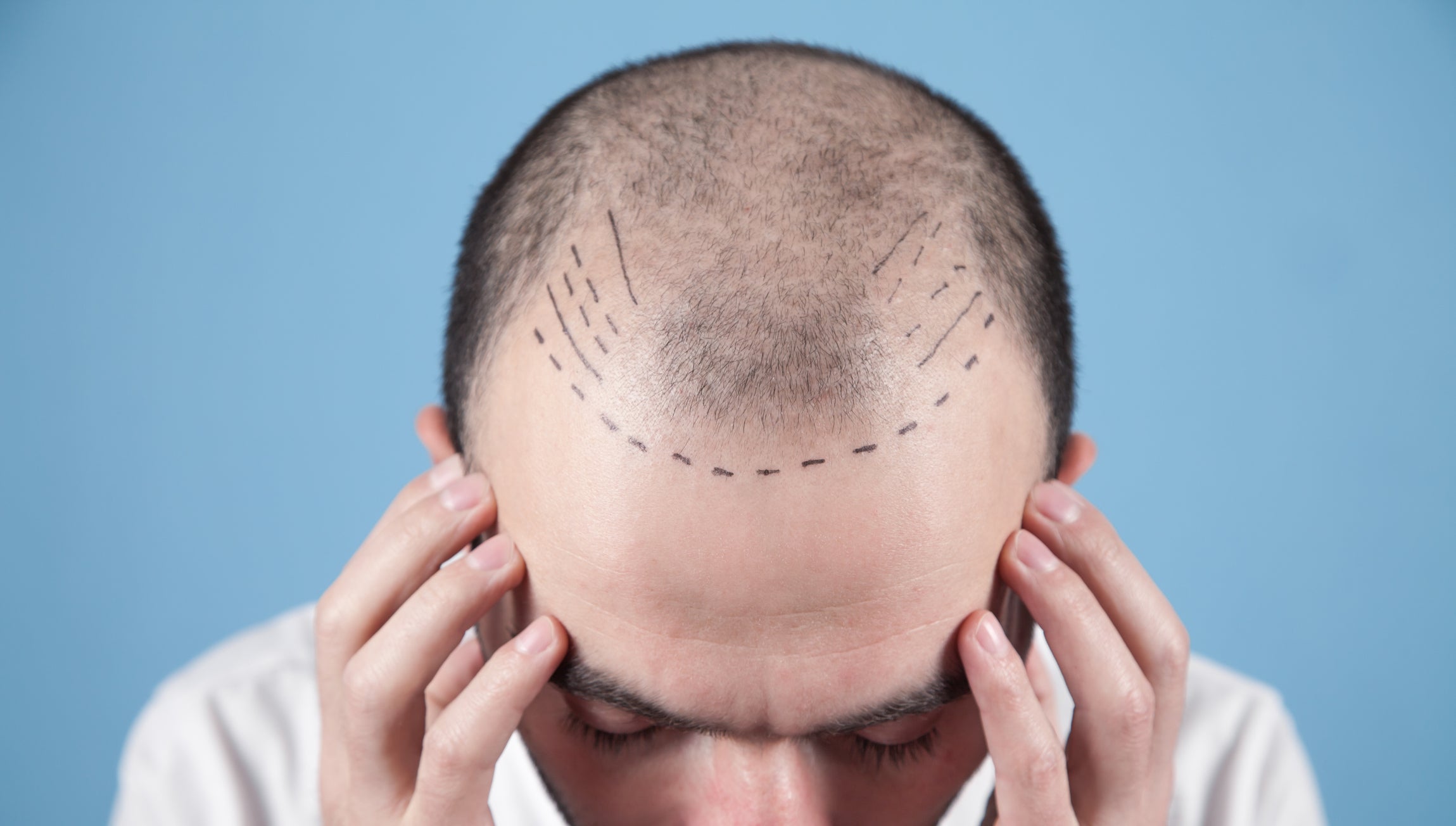 The Complete Guide to Post Hair Transplant Maintenance DS Healthcare Group