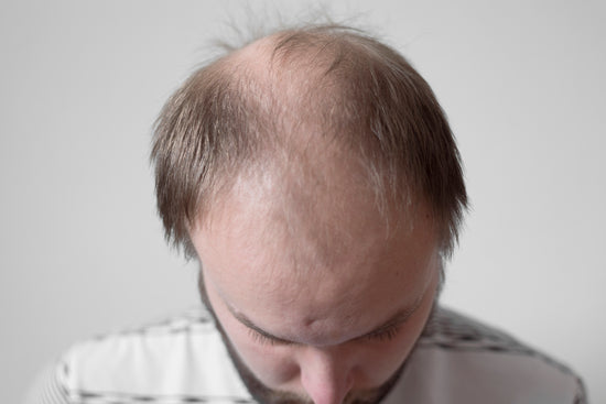 The stages of hair loss and what you should expect