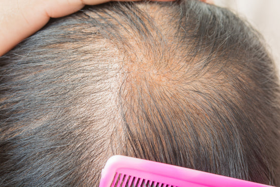 Hair Thinning On One Side of Head - Causes & Solutions – DS