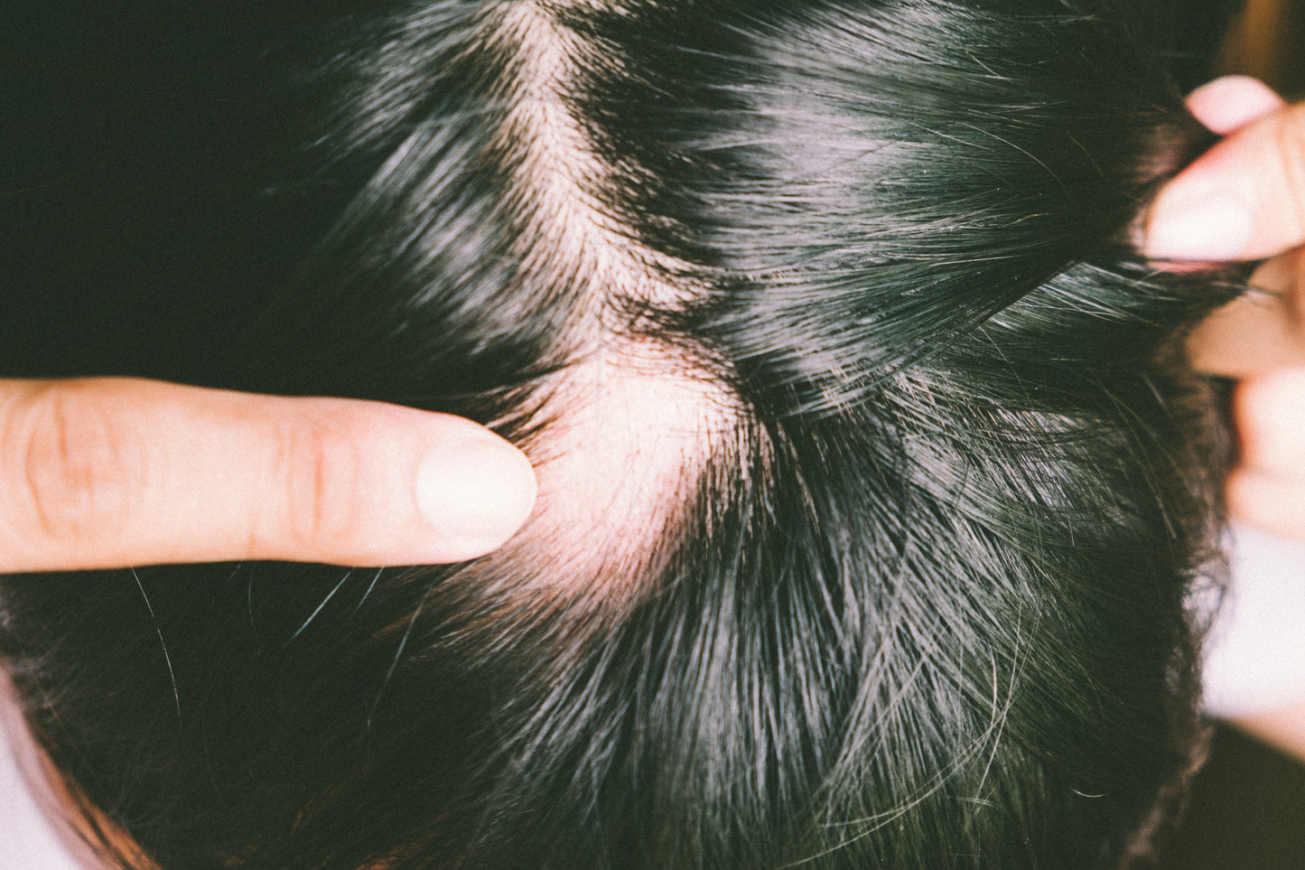 What Are Signs of Permanent Traction Alopecia?