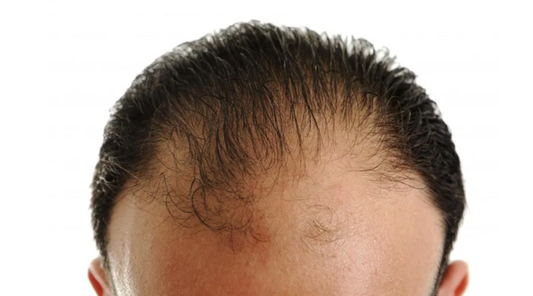 Does Minoxidil (Rogaine) Help With Frontal Baldness?