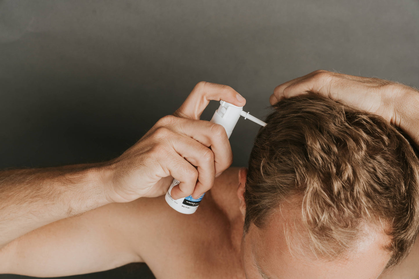 Does Minoxidil For Hair Loss Cause Dandruff?