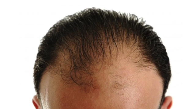 Does Minoxidil (Rogaine) Help With Frontal Baldness?