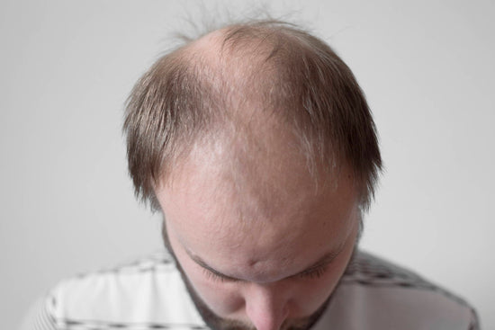 Can Depression Be A Cause of Hair Loss? Here Are 5 Things To Do About It