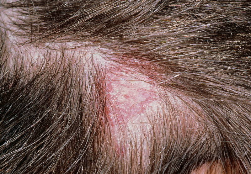 Tinea Capitis vs. Seborrheic Dermatitis