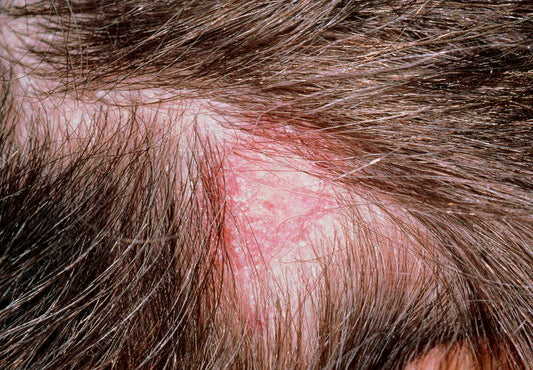 Tinea Capitis vs. Seborrheic Dermatitis