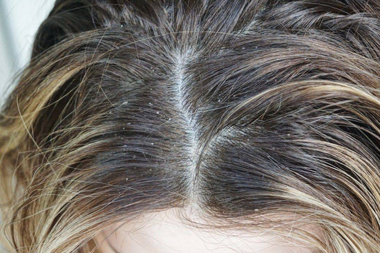 How To Take on Dandruff and Smelly Scalp