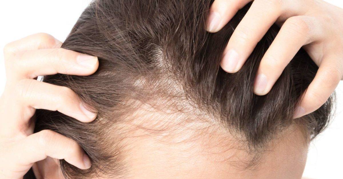 Hair Thinning On One Side of Head - Causes & Solutions