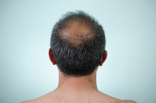 4 Natural DHT Blockers That Can Help with Hair Loss