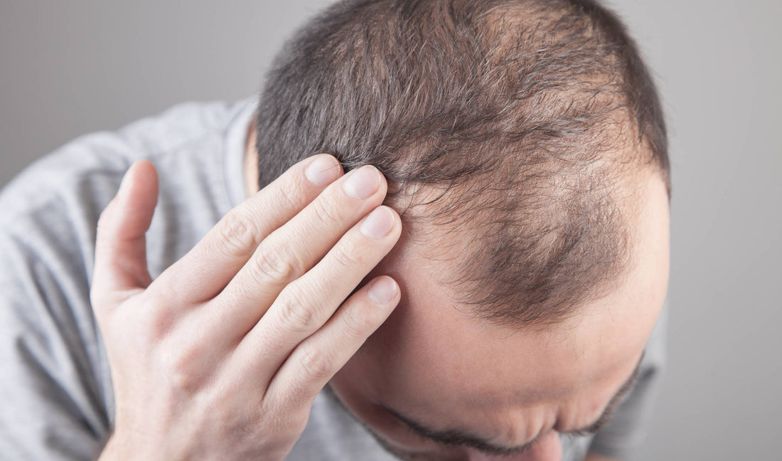 Does Hair Thinning Mean Balding?