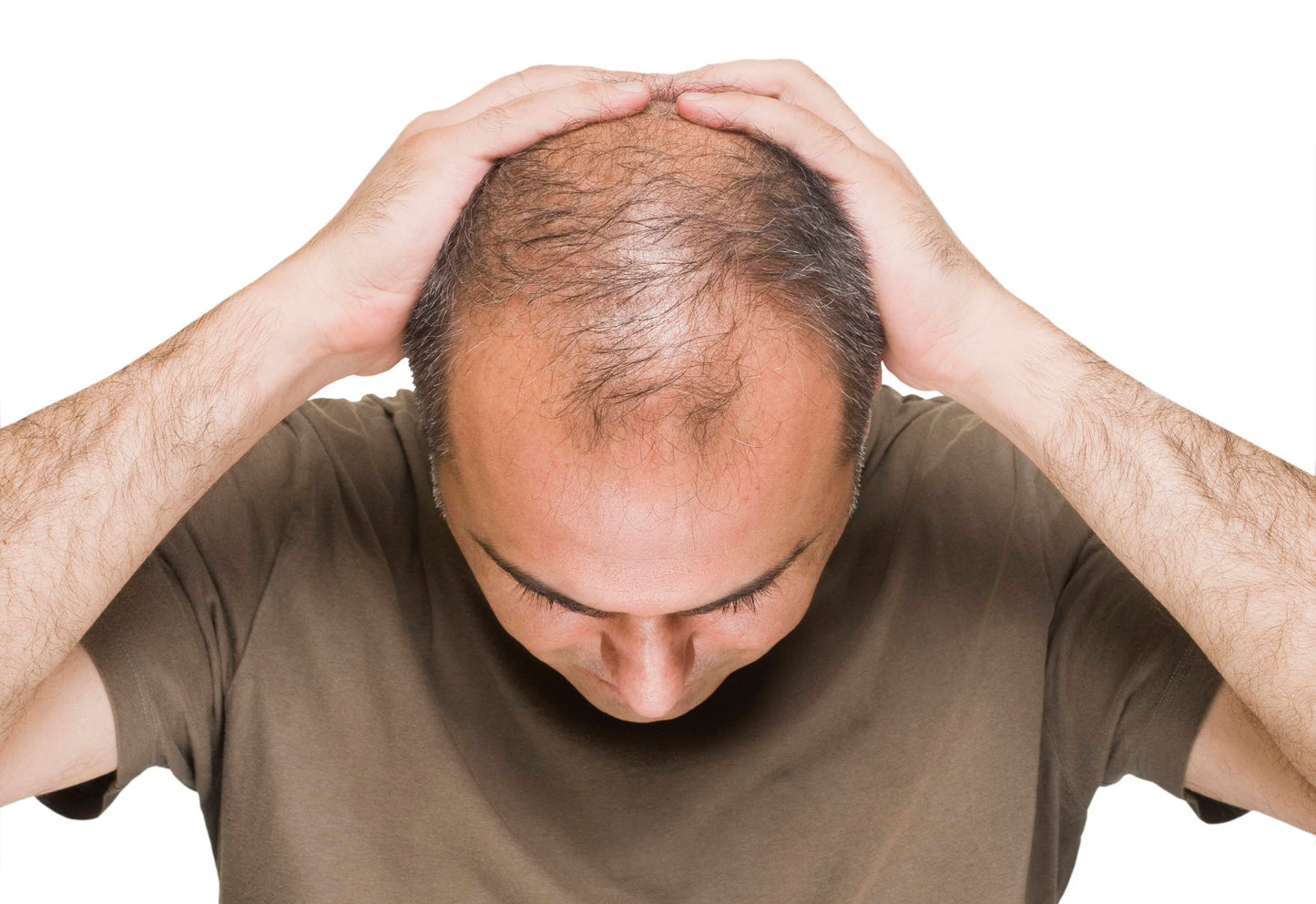 How to Recover from Hair Loss Due to Topical Steroids