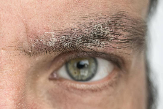 What Causes Dandruff on Eyebrows and How To Get Rid of It