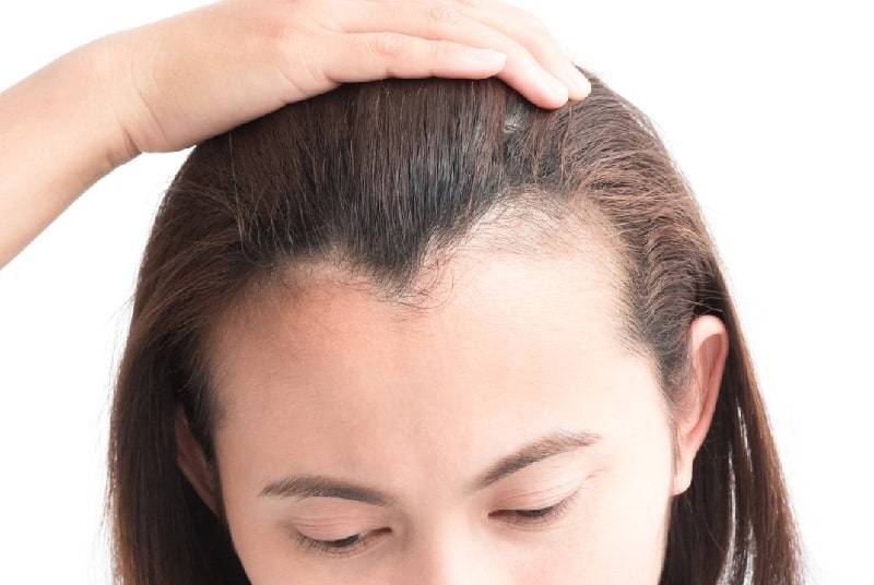 Why Is My Hairline Uneven? Causes & Treatments