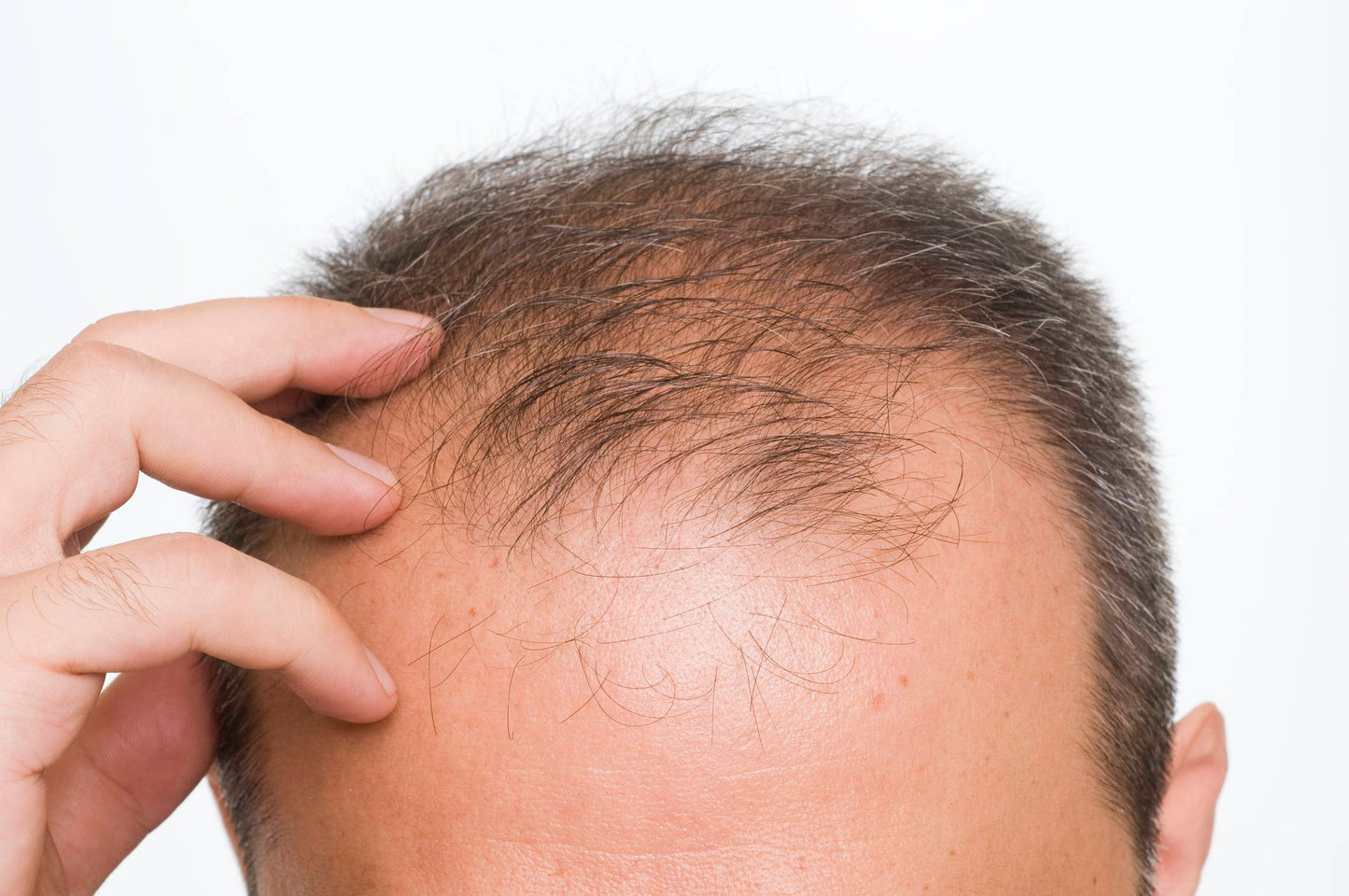 Can Topical Retinoids Cause Hair Loss?