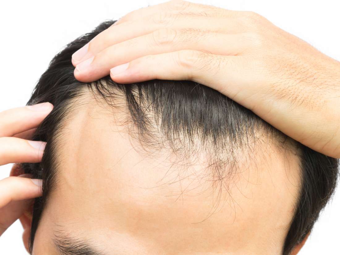 The Receding Hairline Stages for Men & Women