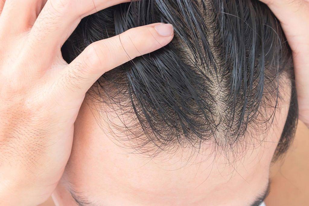 5 Root Causes of Hair Thinning and What To Do About It