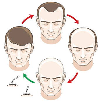Can I Use Normal Shampoo After A Hair Transplant?
