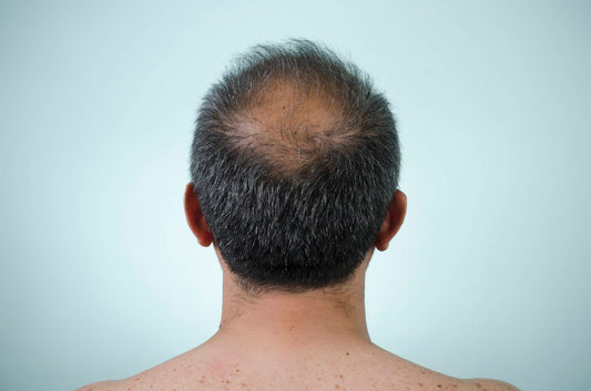 What is DHT & Why Does It Cause Hair Loss?