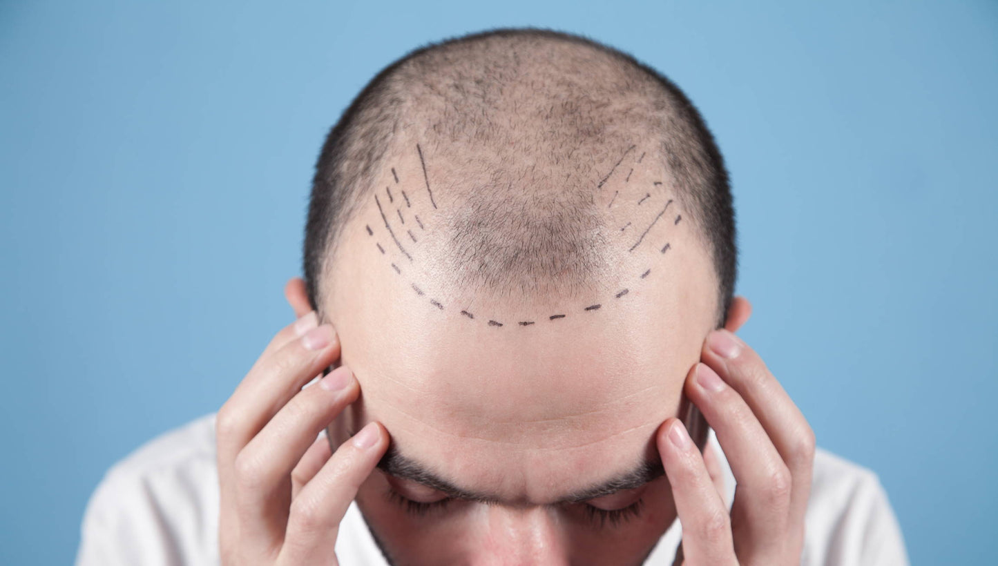 How to Sleep After an FUE Hair Transplant