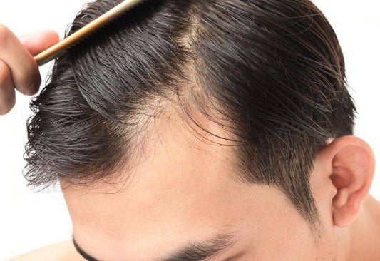 Does Minoxidil Cause Shedding?