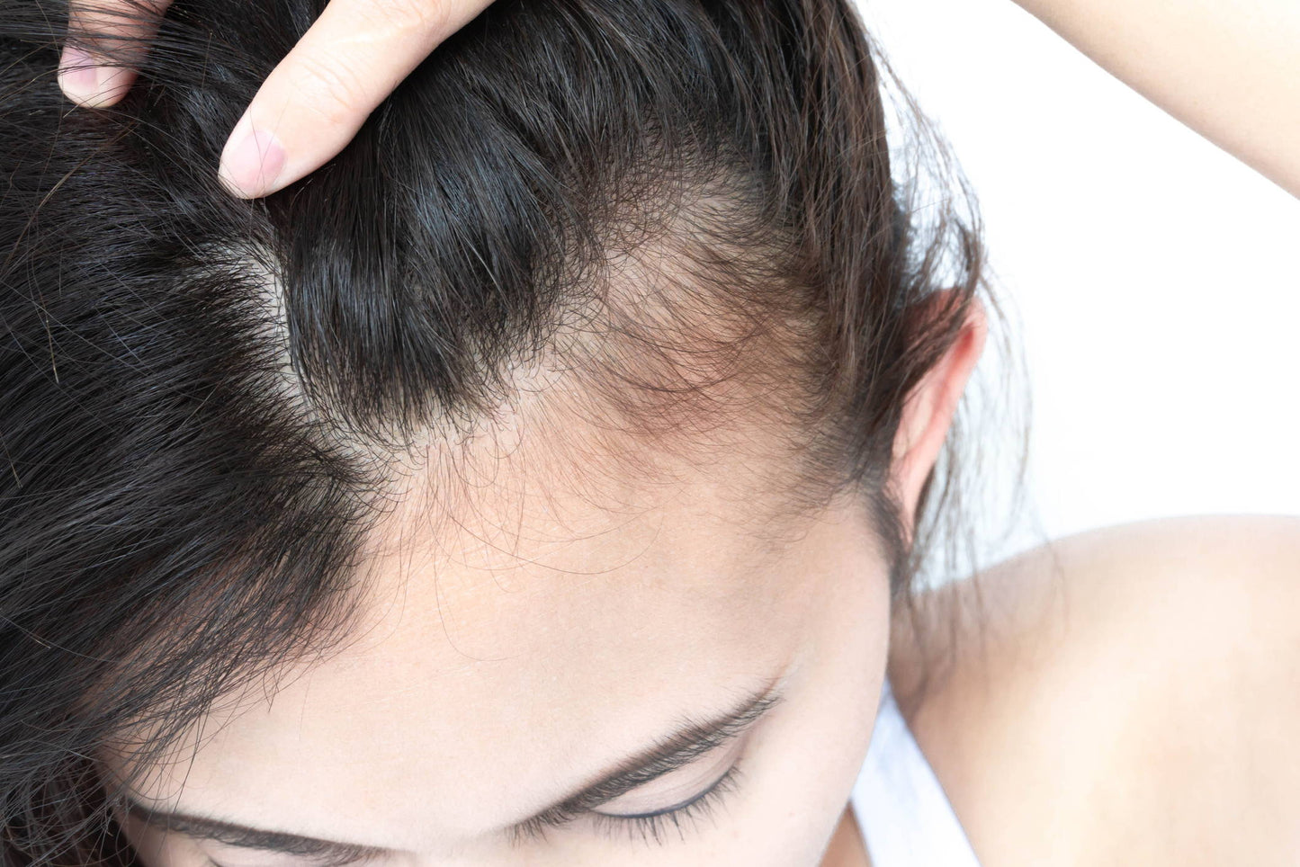 Can Lupus Cause Hair Loss?