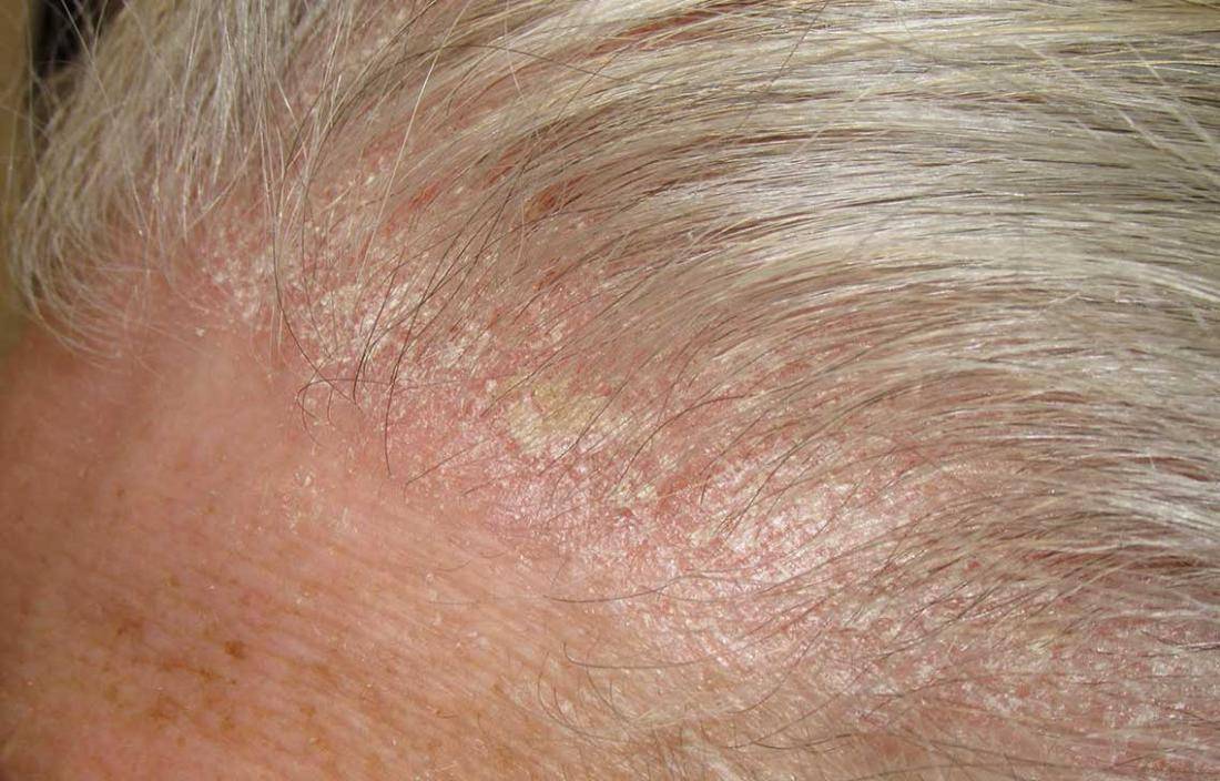 How To Treat A Scabby Scalp