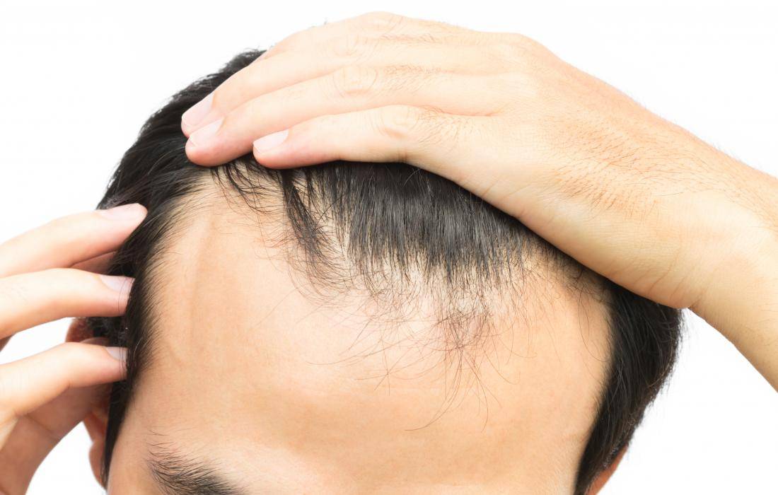 Is Minoxidil an Effective Treatment for a Receding Hairline?