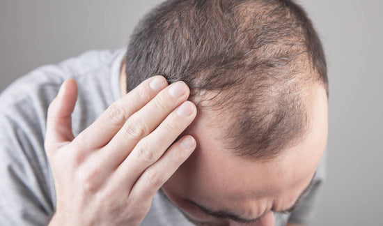 Genetic vs. Reactive Male Hair Loss: Know the Difference