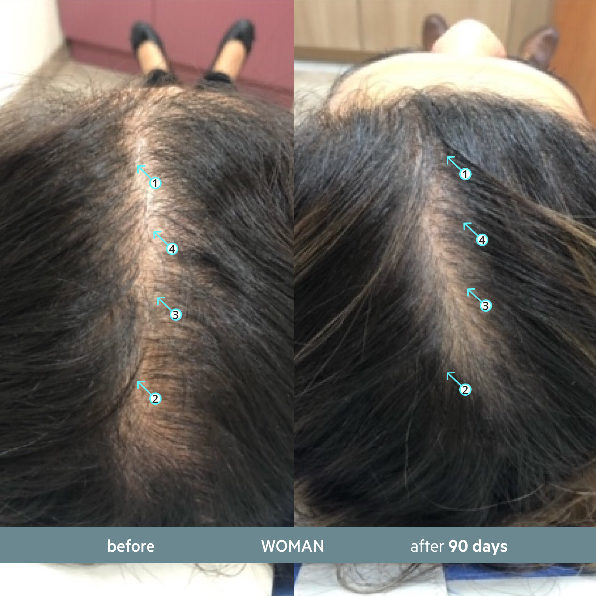 Revita.SOD 2 Pack - 2 Month Supply | Advanced Antioxidant Protection for Hair Longevity