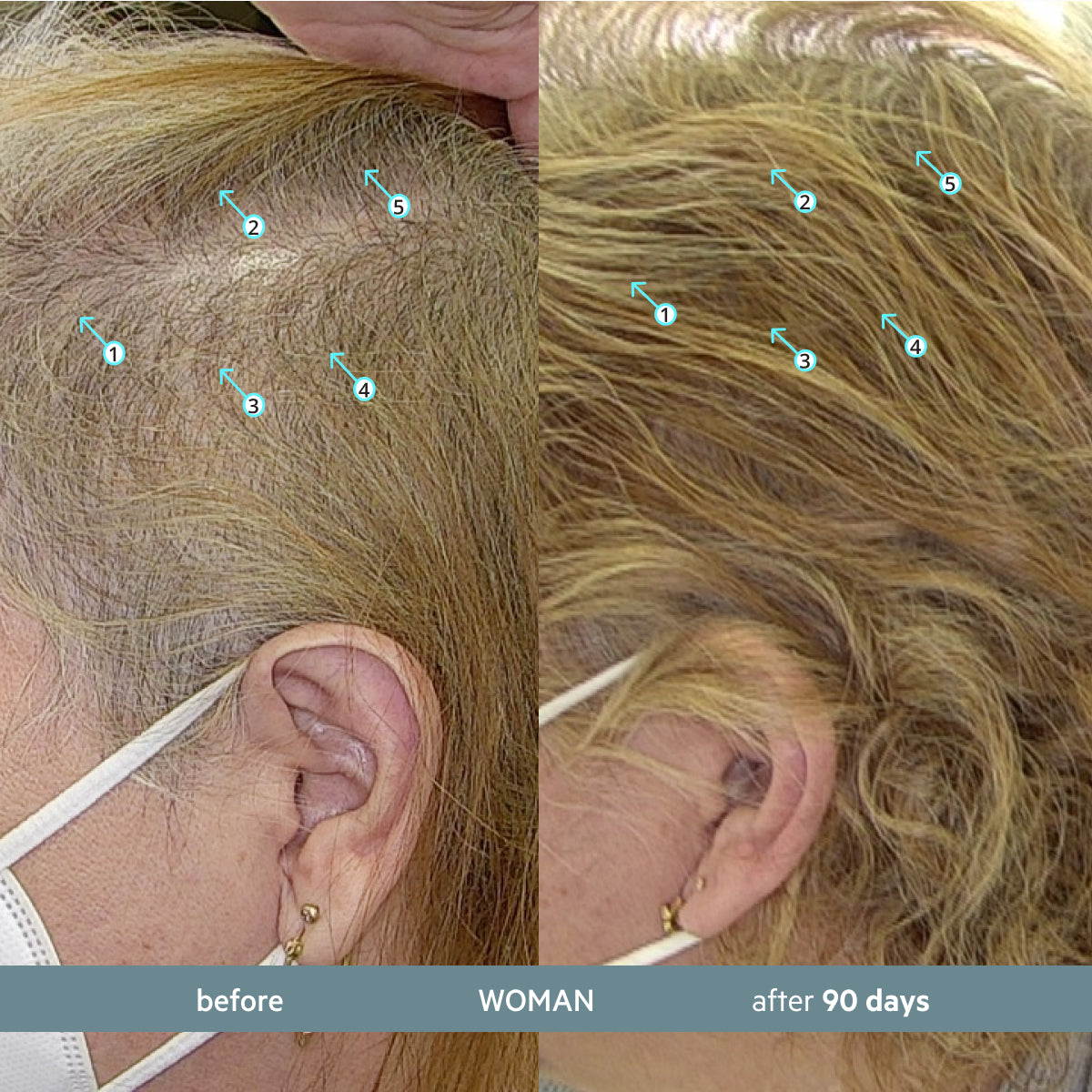 Revita.SOD 2 Pack - 2 Month Supply | Advanced Antioxidant Protection for Hair Longevity