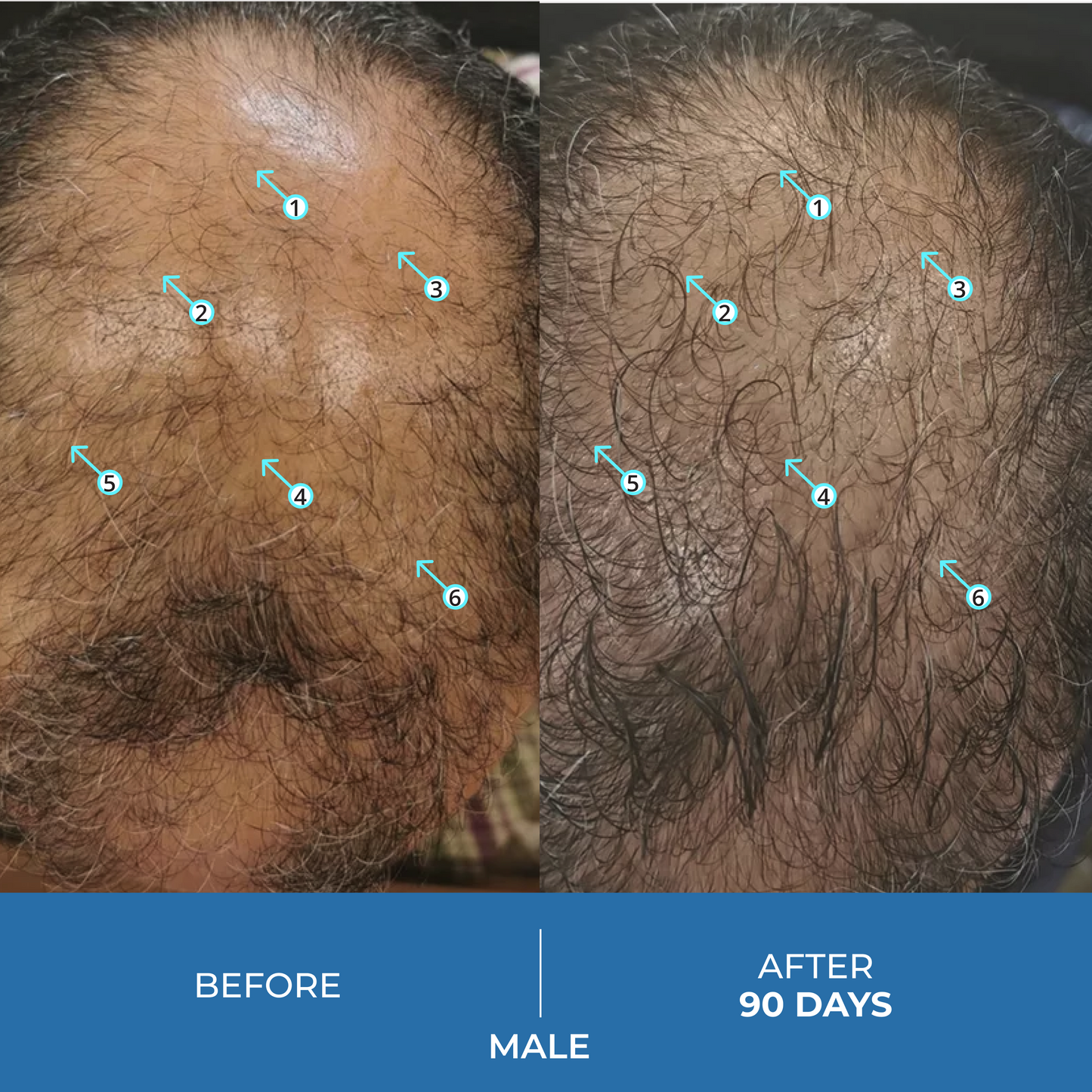 Spectral.UHP | MEN’S Extra Strength Hair Regrowth Treatment with Minoxidil 5%