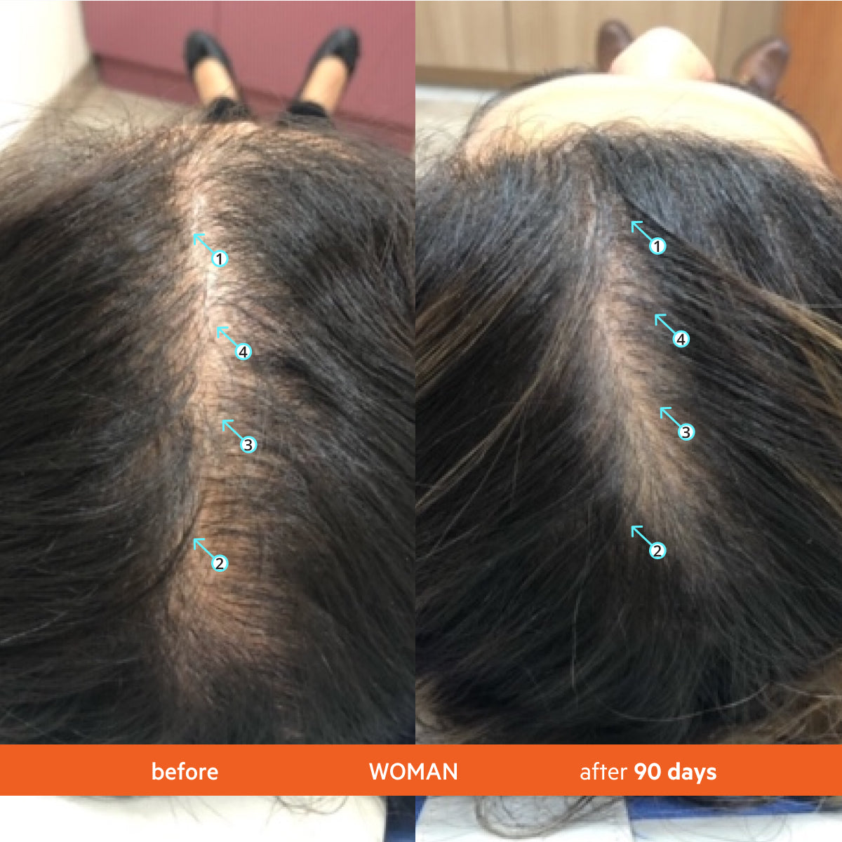 Complete Hair Density Kit | Revita Shampoo/Conditioner + Men's + Booster + Tablets + Stimuroller 0.5